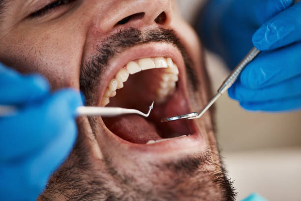Best Emergency Dental Extractions in Air Force Academy, CO
